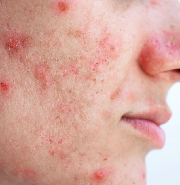Sai lầm 3: Bỏ mặc mụn, để viêm kéo dài gây thâm và sẹo