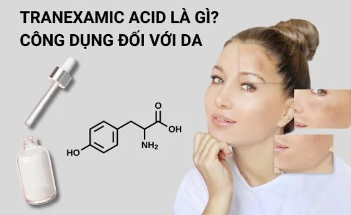 Tranexamic Acid – Giải pháp cho nám và thâm sạm
