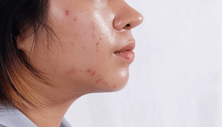 dưỡng da ban đêm cho da dầu