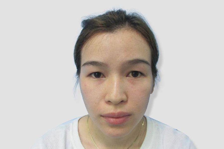 khắc phục sụp mí mắt