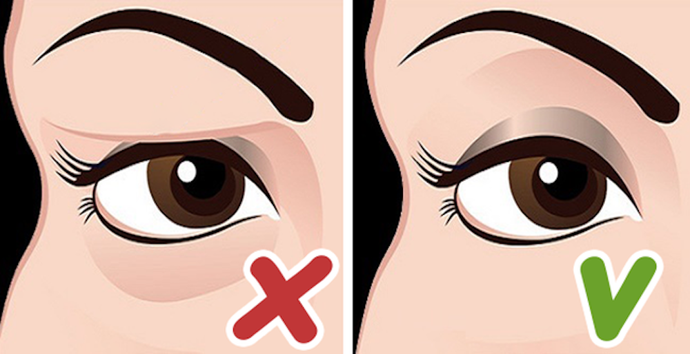 khắc phục sụp mí mắt
