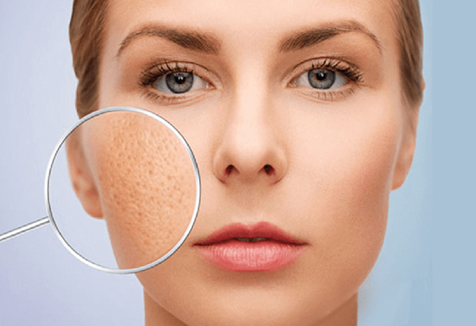 Lỗ chân lông lớn khiến da mất đi sự săn chắc và mịn màng.